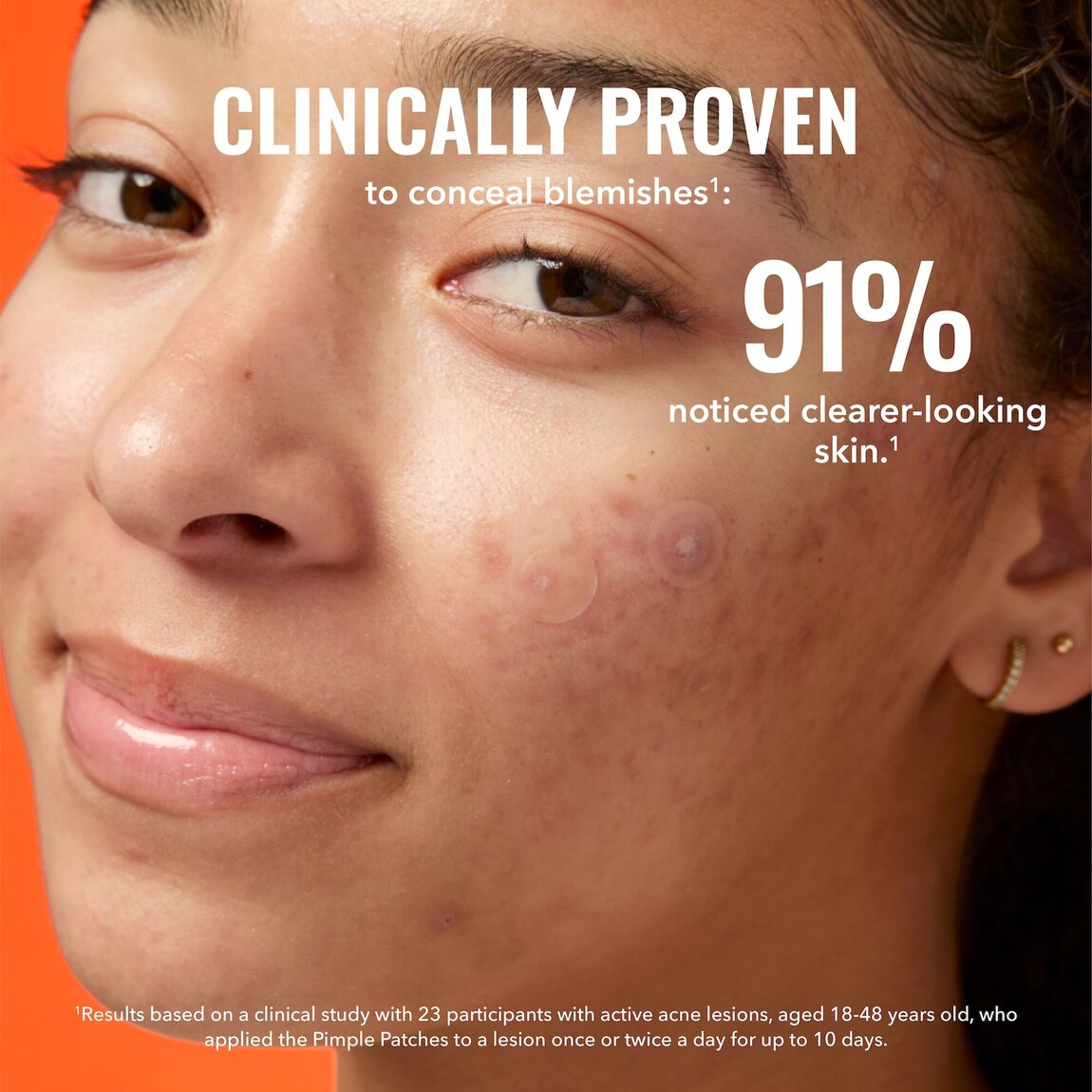 pimple-patches-x9 zb_p.jpg