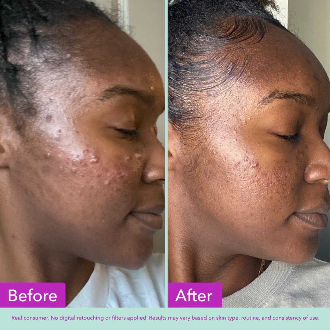 acne-foaming-cleanser-i9 zb_p.jpg